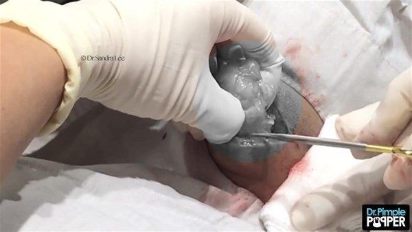 Görenlerin midesi bulanıyor! Ensesindeki kocaman şişlikten çıkanlar şaşırtıyor - Resim: 12