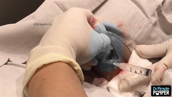 Görenlerin midesi bulanıyor! Ensesindeki kocaman şişlikten çıkanlar şaşırtıyor - Resim: 13