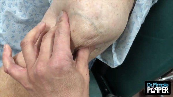 Kolundaki şişlikten bakın ne çıktı! Giderek şişmeye başlayınca dayanamayıp doktorun yolunu tuttu - Resim: 1