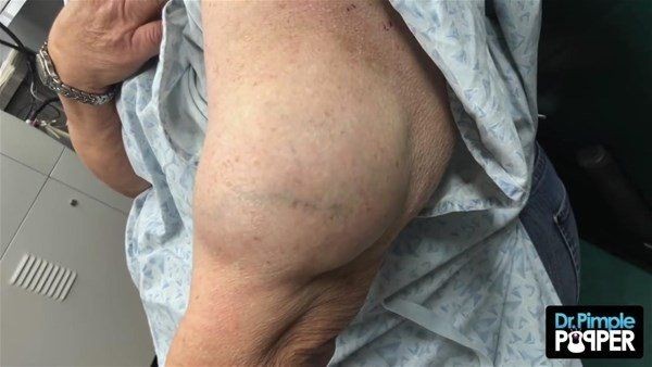 Kolundaki şişlikten bakın ne çıktı! Giderek şişmeye başlayınca dayanamayıp doktorun yolunu tuttu - Resim: 2