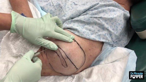 Kolundaki şişlikten bakın ne çıktı! Giderek şişmeye başlayınca dayanamayıp doktorun yolunu tuttu - Resim: 4