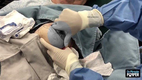 Kolundaki şişlikten bakın ne çıktı! Giderek şişmeye başlayınca dayanamayıp doktorun yolunu tuttu - Resim: 7