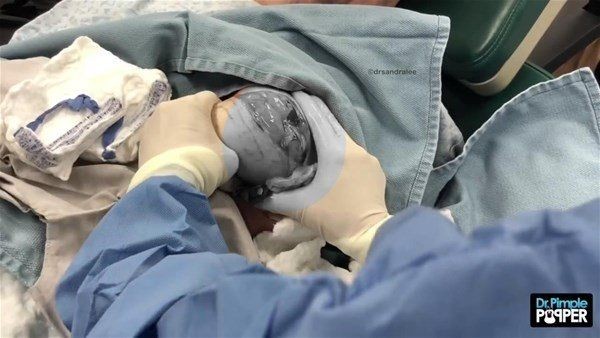 Kolundaki şişlikten bakın ne çıktı! Giderek şişmeye başlayınca dayanamayıp doktorun yolunu tuttu - Resim: 8