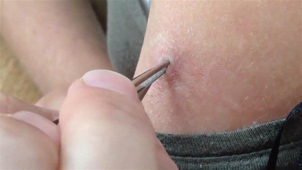 Vücutlarından kurtçuk fışkırıyor! Depremzede ailenin hayatı kabusa döndü! Doktorlar bile şaştı kaldı - Resim: 12