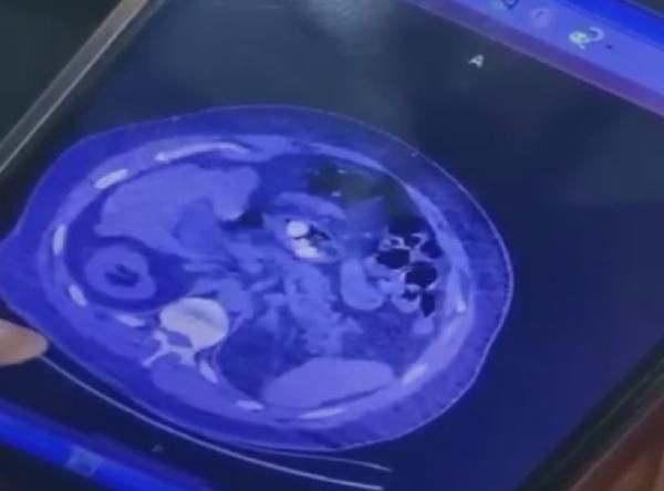Feci ölüm! Midesine sakladığı uyuşturucu dolu kapsüller patladı! Son anları kamerada - Resim: 9