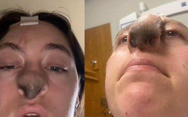 Ameliyattan sonra hayatı değişti! Burnundan saç çıkan kadını gören dönüp bir daha bakıyor! - Resim: 12
