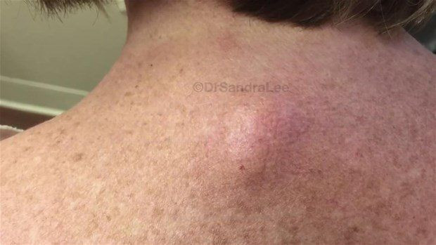 Boynunda sivilce zannettiği şişlikten bakın ne çıktı! Giderek büyüyünce doktor bile şaştı kaldı - Resim: 1