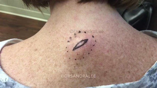 Boynunda sivilce zannettiği şişlikten bakın ne çıktı! Giderek büyüyünce doktor bile şaştı kaldı - Resim: 2