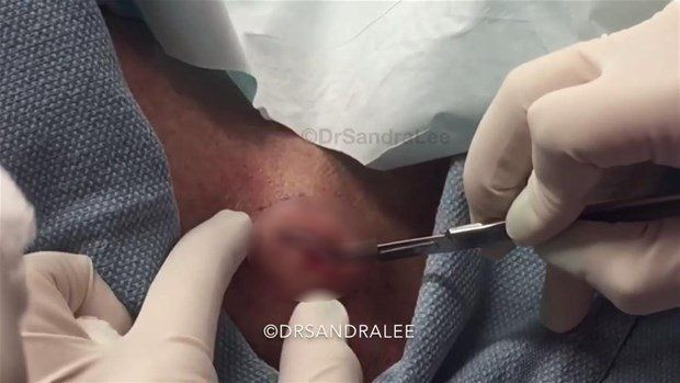 Boynunda sivilce zannettiği şişlikten bakın ne çıktı! Giderek büyüyünce doktor bile şaştı kaldı - Resim: 5