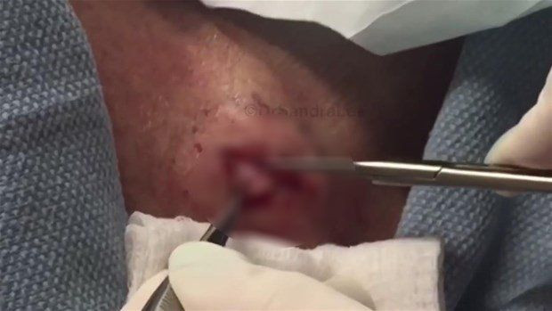 Boynunda sivilce zannettiği şişlikten bakın ne çıktı! Giderek büyüyünce doktor bile şaştı kaldı - Resim: 6