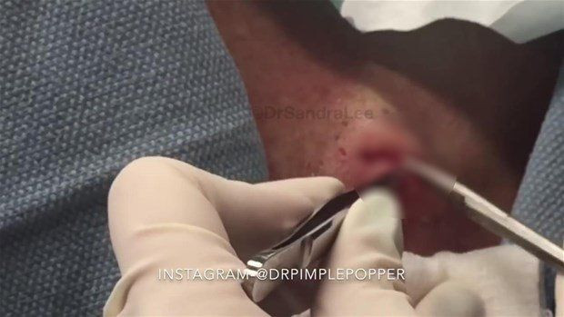 Boynunda sivilce zannettiği şişlikten bakın ne çıktı! Giderek büyüyünce doktor bile şaştı kaldı - Resim: 7