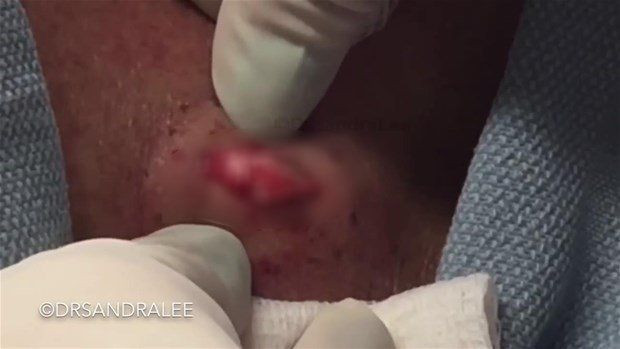 Boynunda sivilce zannettiği şişlikten bakın ne çıktı! Giderek büyüyünce doktor bile şaştı kaldı - Resim: 8