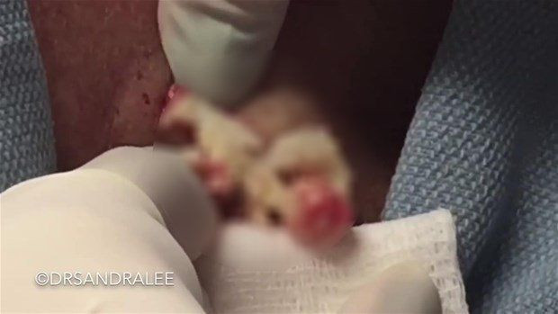 Boynunda sivilce zannettiği şişlikten bakın ne çıktı! Giderek büyüyünce doktor bile şaştı kaldı - Resim: 10