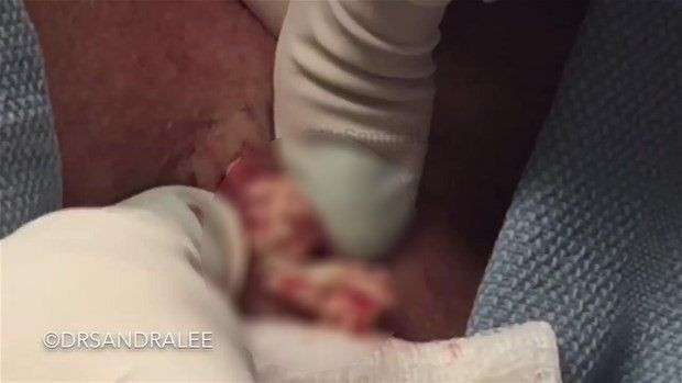 Boynunda sivilce zannettiği şişlikten bakın ne çıktı! Giderek büyüyünce doktor bile şaştı kaldı - Resim: 13