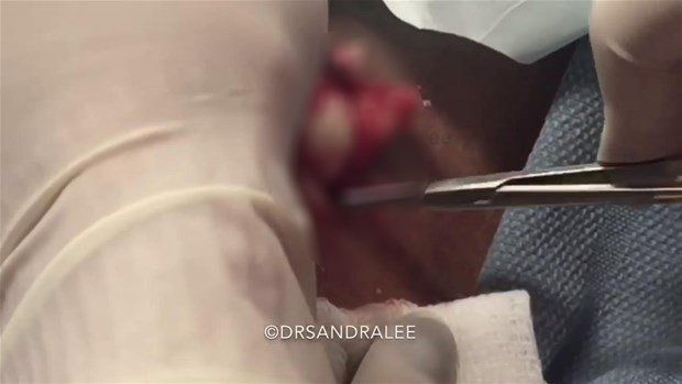 Boynunda sivilce zannettiği şişlikten bakın ne çıktı! Giderek büyüyünce doktor bile şaştı kaldı - Resim: 15