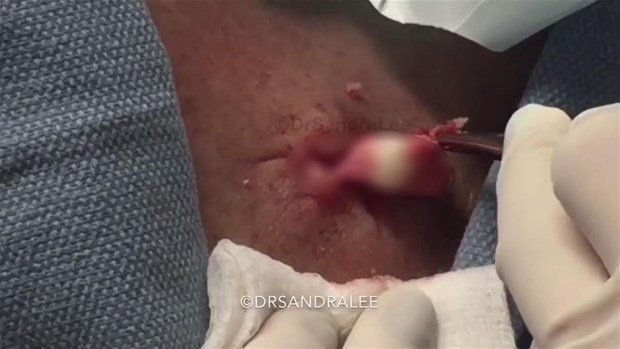 Boynunda sivilce zannettiği şişlikten bakın ne çıktı! Giderek büyüyünce doktor bile şaştı kaldı - Resim: 16