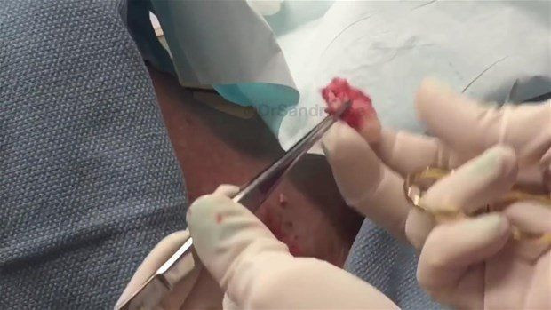 Boynunda sivilce zannettiği şişlikten bakın ne çıktı! Giderek büyüyünce doktor bile şaştı kaldı - Resim: 17