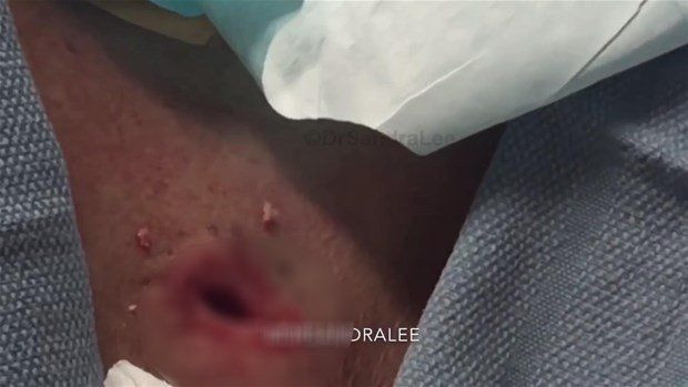 Boynunda sivilce zannettiği şişlikten bakın ne çıktı! Giderek büyüyünce doktor bile şaştı kaldı - Resim: 18