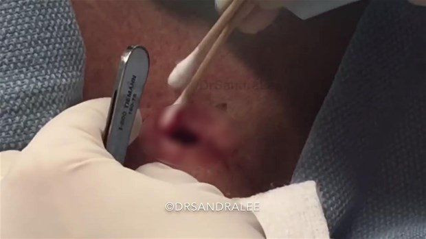 Boynunda sivilce zannettiği şişlikten bakın ne çıktı! Giderek büyüyünce doktor bile şaştı kaldı - Resim: 19