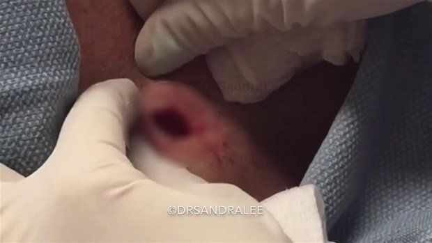 Boynunda sivilce zannettiği şişlikten bakın ne çıktı! Giderek büyüyünce doktor bile şaştı kaldı - Resim: 20