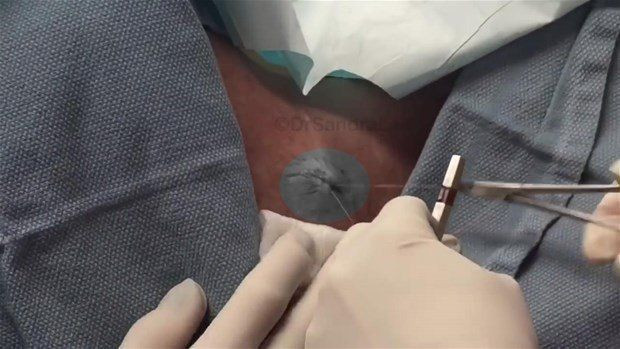 Boynunda sivilce zannettiği şişlikten bakın ne çıktı! Giderek büyüyünce doktor bile şaştı kaldı - Resim: 22