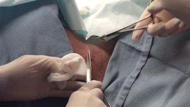 Boynunda sivilce zannettiği şişlikten bakın ne çıktı! Giderek büyüyünce doktor bile şaştı kaldı - Resim: 23