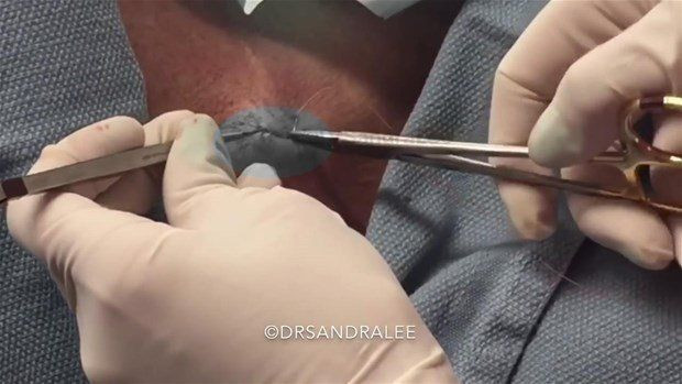 Boynunda sivilce zannettiği şişlikten bakın ne çıktı! Giderek büyüyünce doktor bile şaştı kaldı - Resim: 24