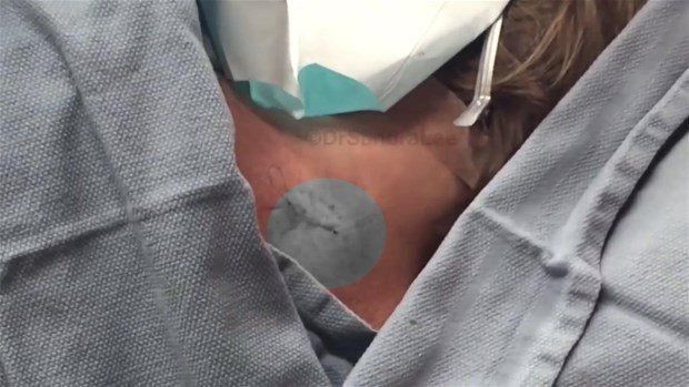 Boynunda sivilce zannettiği şişlikten bakın ne çıktı! Giderek büyüyünce doktor bile şaştı kaldı - Resim: 25