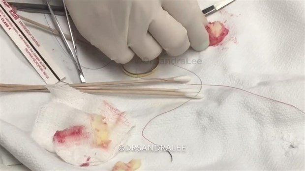 Boynunda sivilce zannettiği şişlikten bakın ne çıktı! Giderek büyüyünce doktor bile şaştı kaldı - Resim: 26
