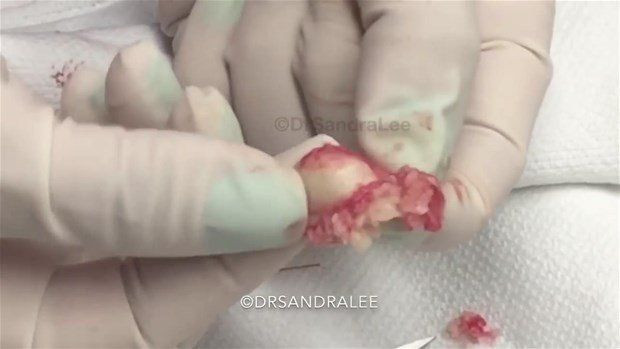 Boynunda sivilce zannettiği şişlikten bakın ne çıktı! Giderek büyüyünce doktor bile şaştı kaldı - Resim: 27
