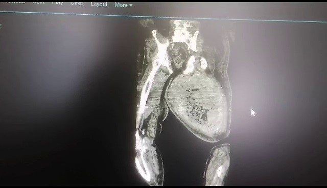 Ayak ağrısı için hastaneye gitti! Doktorlar gözlerine inanamadı! Ameliyat sonrası tam 8.9 kilo zayıfladı - Resim: 7