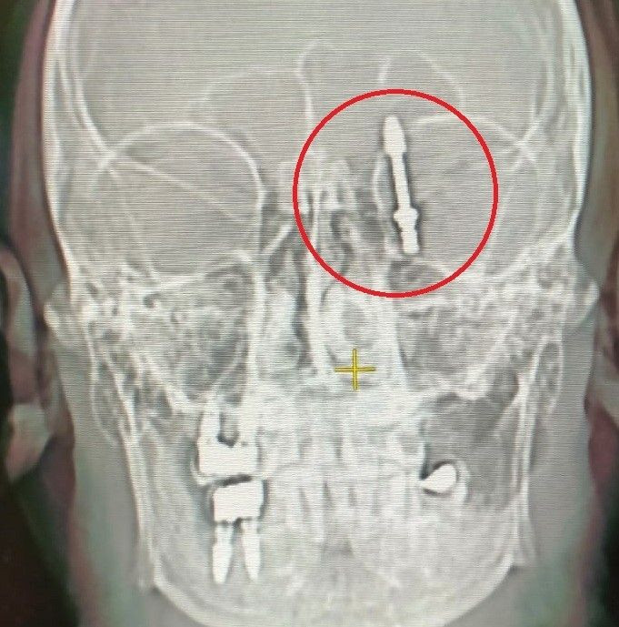 Beynine saplanan implant hayatını kararttı: 2 yıldır adalet bekliyor - Resim: 5