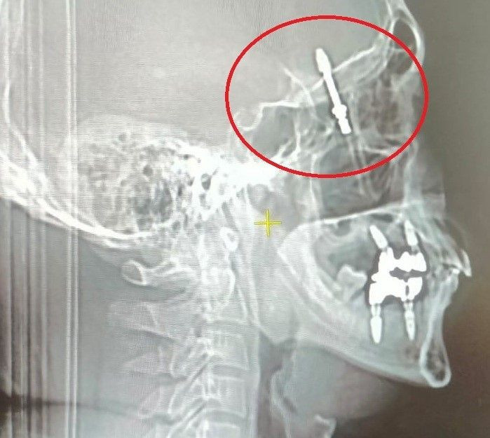 Beynine saplanan implant hayatını kararttı: 2 yıldır adalet bekliyor - Resim: 2