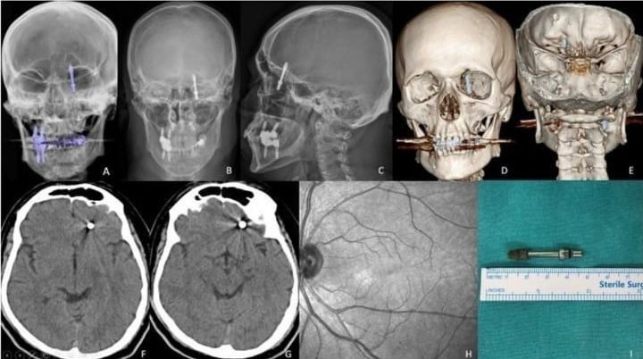 Beynine saplanan implant hayatını kararttı: 2 yıldır adalet bekliyor - Resim: 3