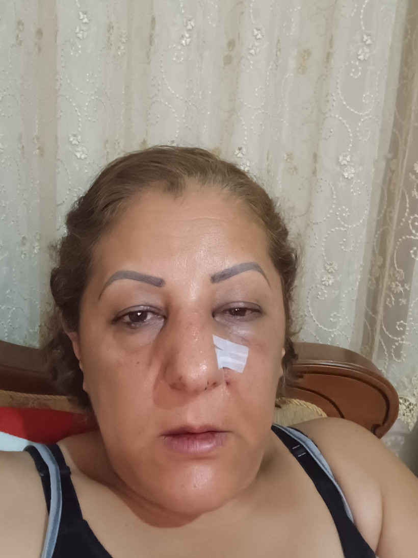 Bahçedeki kedileri besledi diye komşusunun saldırısına uğradı! Talihsiz kadının burnu kırıldı - Resim : 4