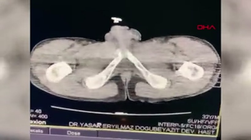 Bağırsaklarından 432 gram afyon sakızı çıktı