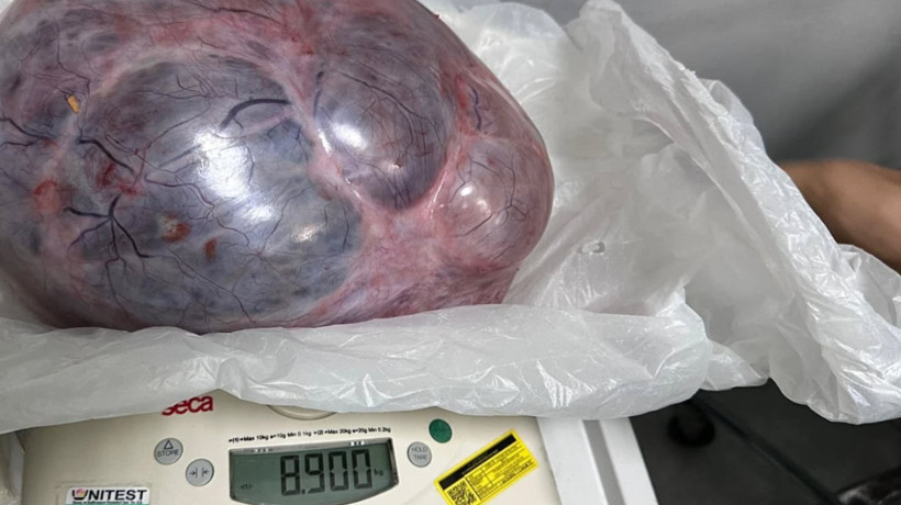 Yumurtalıklarındaki 9 kiloluk kitle operasyonla çıkarıldı
