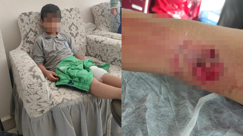Okula giderken sokak köpeğinin saldırısına uğradı