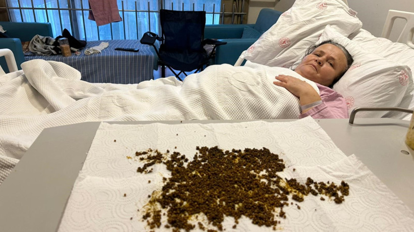 Karın ağrısı şikayetiyle gitti tıp dünyasını şoke etti! Çıkan taşları yapay zekaya saydırabildiler