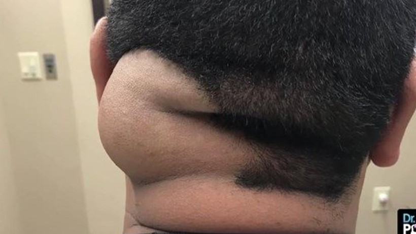 Görenlerin midesi bulanıyor! Ensesindeki kocaman şişlikten çıkanlar şaşırtıyor - Resim: 1