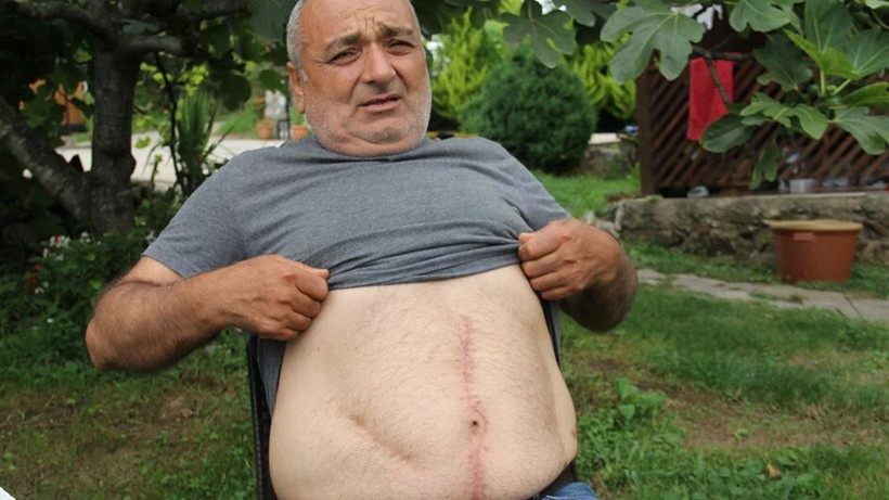 Karın sancısı nedeniyle 18 yıl görmediği tedavi kalmadı! Ortaya çıkan gerçek şoke etti | Karnından bakın ne çıktı - Resim: 2