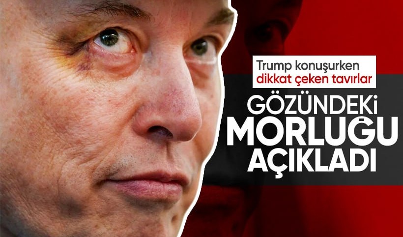 Musk’ın gözündeki morluğun sırrı: Küçük X yumruk attı