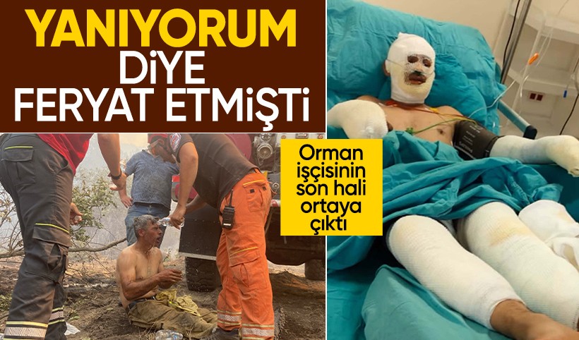 "Yanıyorum" diye feryat eden orman işçisi Kader Dereli’nin tedavisi sürüyor
