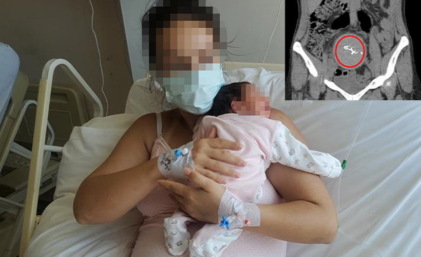 2 yıl sonra ortaya çıktı: Doğumda unutulan cisme soruşturma