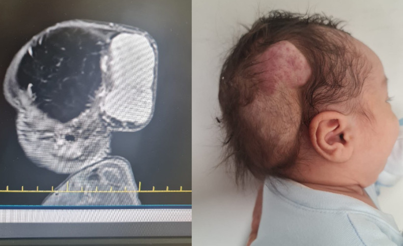 Talha bebeğin dünyada nadir görülen beyin tümörü, 4 saatlik operasyonla alındı