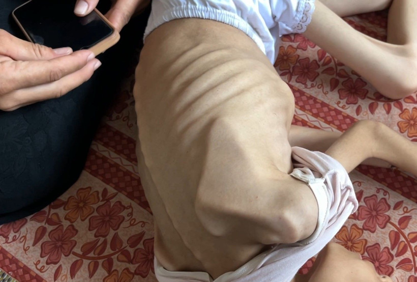 Gazze'de açlıkla mücadele: 9 yaşındaki Meryem 10 kiloya düştü - Resim: 5