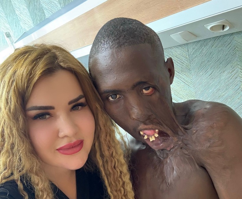 9 yaşındayken feci şekilde yanan Ugandalı çobanın imdadına Türk hekimler koştu - Resim: 1