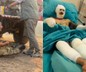 "Yanıyorum" diye feryat eden orman işçisi Kader Dereli’nin tedavisi sürüyor